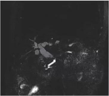 梗阻性黄疸做了胆道支架,胆道梗阻性黄疸胆管穿刺引流