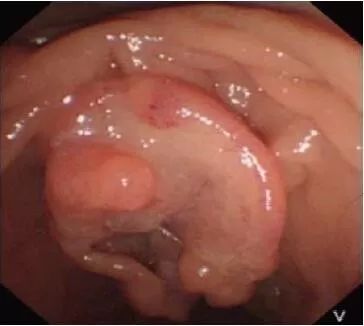 梗阻性黄疸做了胆道支架,胆道梗阻性黄疸胆管穿刺引流