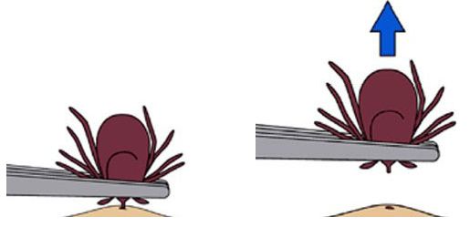 女孩被多蚊叮咬后变异,蚊虫叮咬会得癫痫病吗