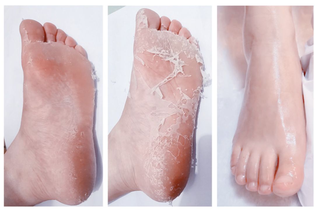 嫩脚神器告别死皮,脚死皮神器第一名