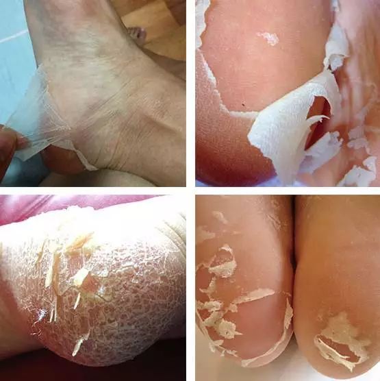 嫩脚神器告别死皮,脚死皮神器第一名