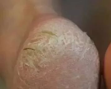 嫩脚神器告别死皮,脚死皮神器第一名