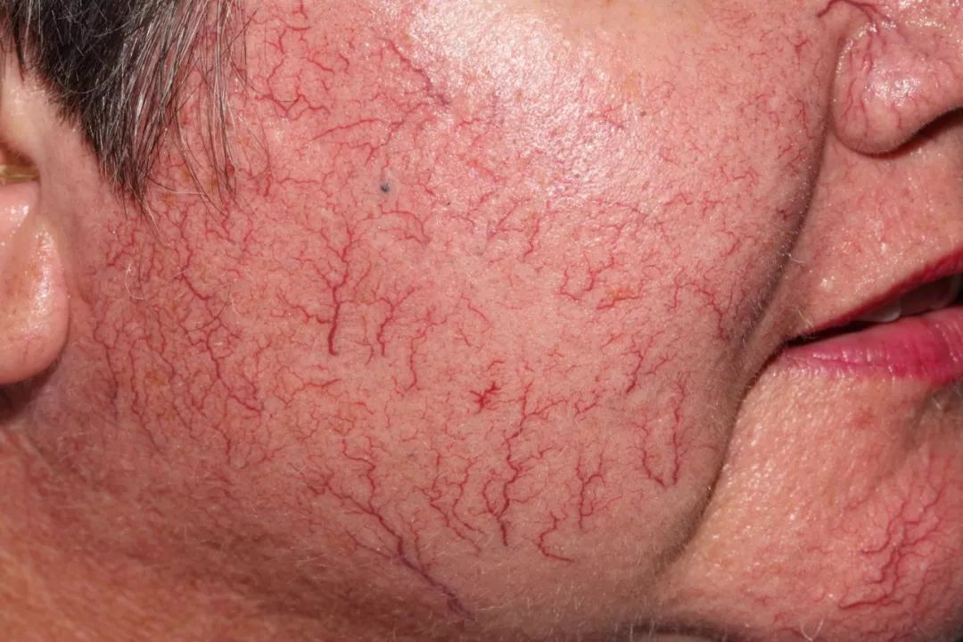 脸上的红血丝怎么处理,脸上的红血丝怎么解决