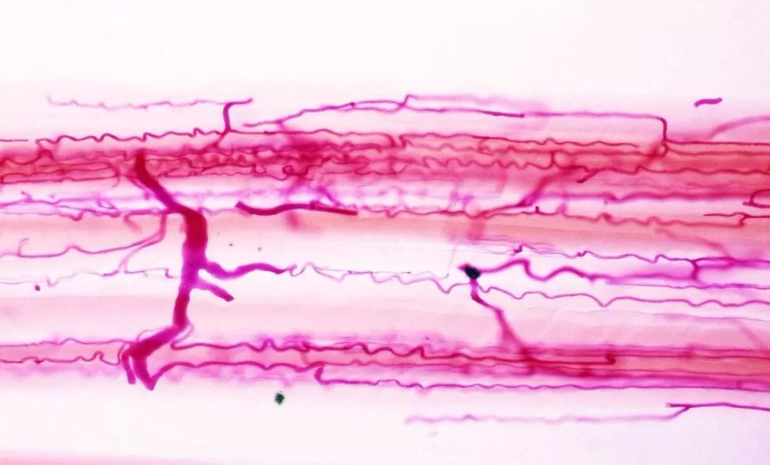 脸上的红血丝怎么处理,脸上的红血丝怎么解决