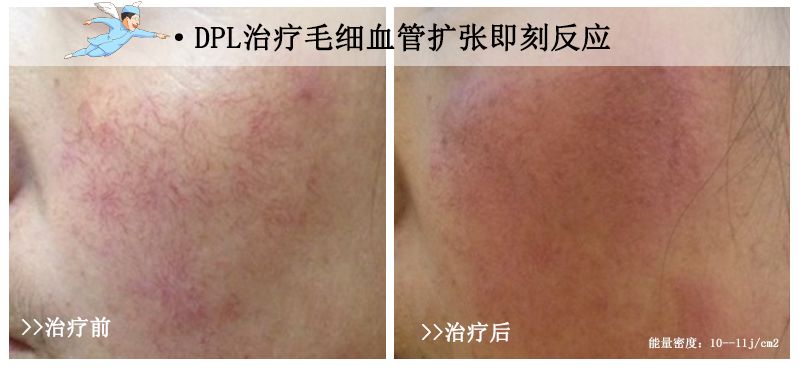 脸上的红血丝怎么处理,脸上的红血丝怎么解决