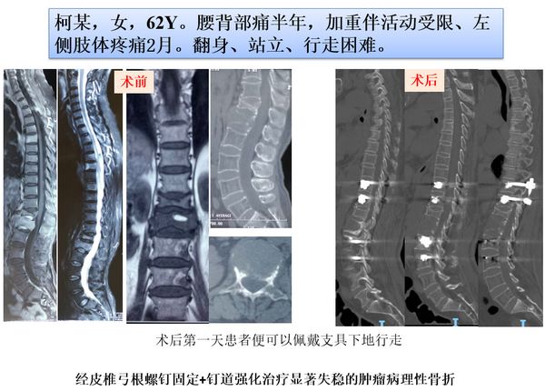 「筋骨堂」脊柱肿瘤可精准诊断，治疗选择大小皆宜