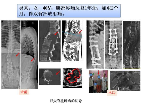 「筋骨堂」脊柱肿瘤可精准诊断，治疗选择大小皆宜