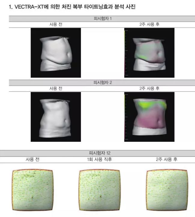 无需抽脂的韩国溶脂仪，2周抚平橘皮，腰围还瘦3cm