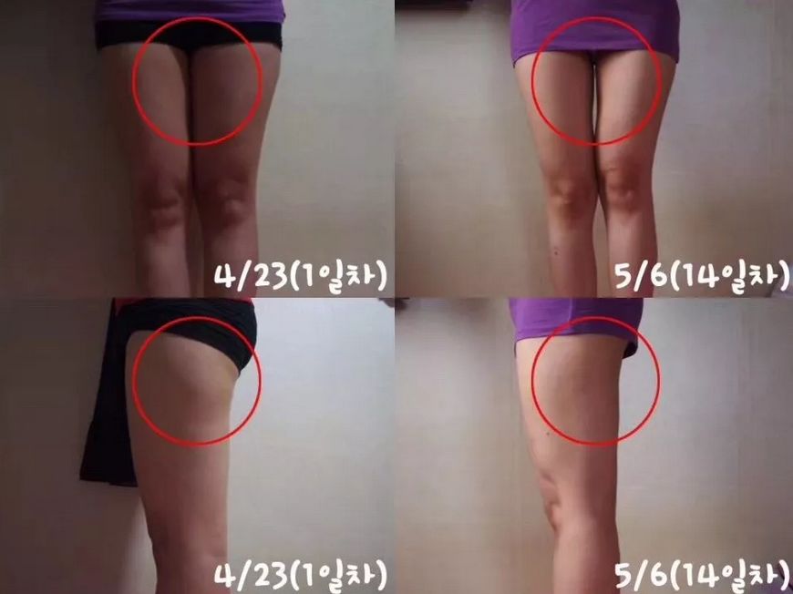 无需抽脂的韩国溶脂仪，2周抚平橘皮，腰围还瘦3cm