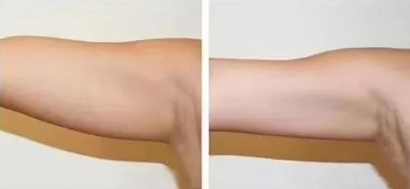 无需抽脂的韩国溶脂仪，2周抚平橘皮，腰围还瘦3cm