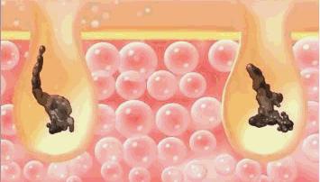 20分钟清理背部螨虫痘痘,十秒去除螨虫