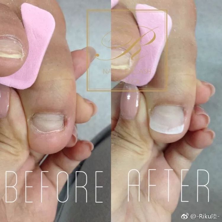 怎么治疗灰趾甲才能彻底不反复,如何快速自然地摆脱指甲真菌