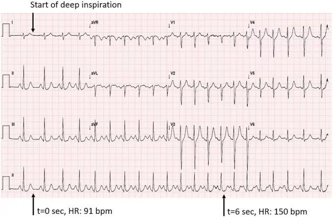 深呼吸引起房颤,深呼吸引起早搏