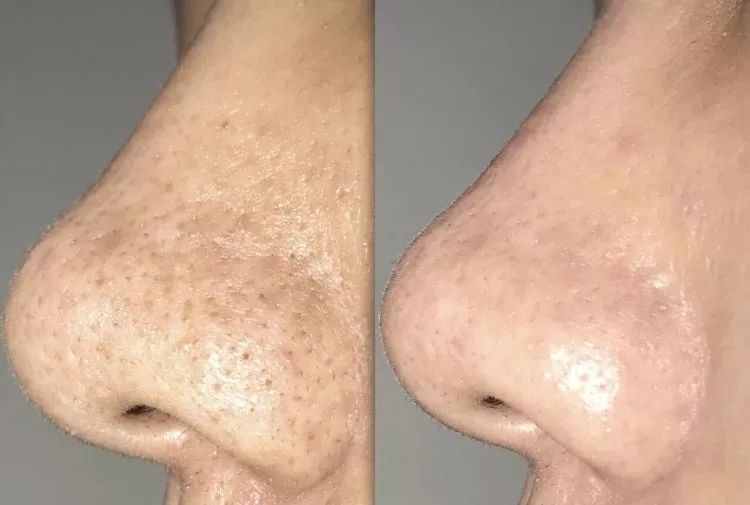 草莓鼻救星怎么治疗,草莓鼻去黑头神器视频