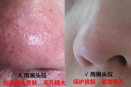 草莓鼻救星怎么治疗,草莓鼻去黑头神器视频