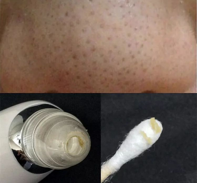 草莓鼻救星怎么治疗,草莓鼻去黑头神器视频