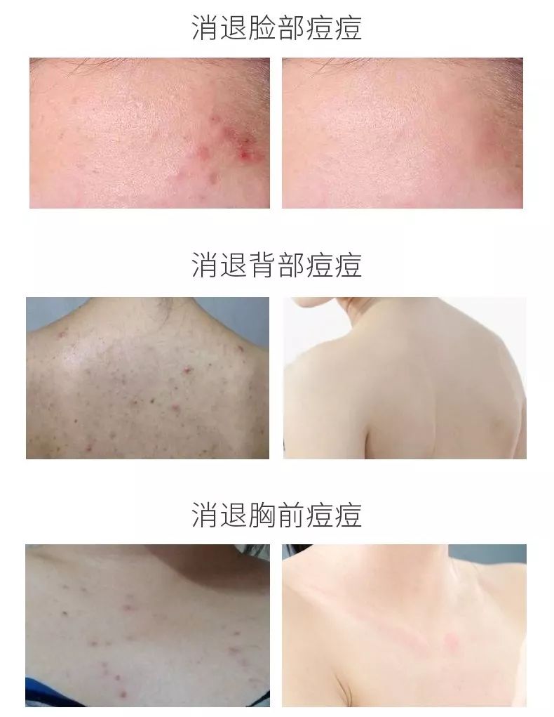 20分钟清理背部螨虫痘痘,十秒去除螨虫