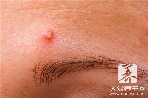 天疱疮是什么引起的,天疱疮怎么治疗