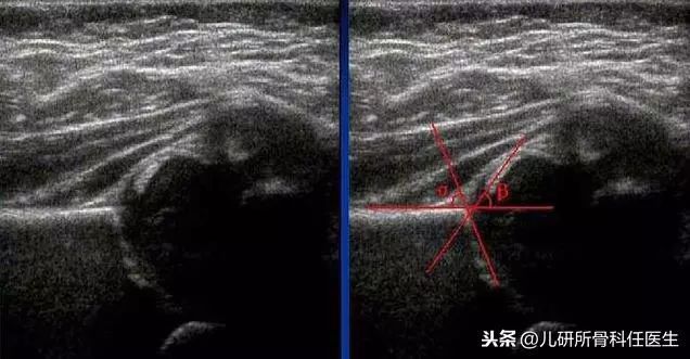 孩子臀纹不对称，看完门诊还是不明白？一次性解答你所有问题