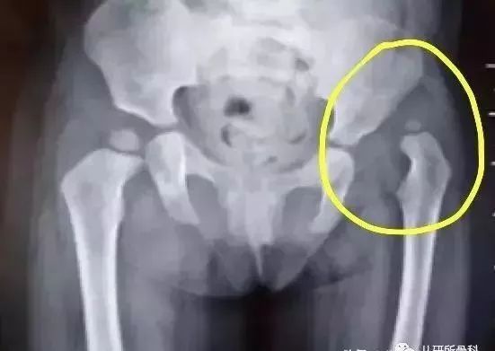 孩子臀纹不对称，看完门诊还是不明白？一次性解答你所有问题