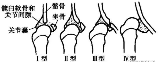孩子臀纹不对称，看完门诊还是不明白？一次性解答你所有问题