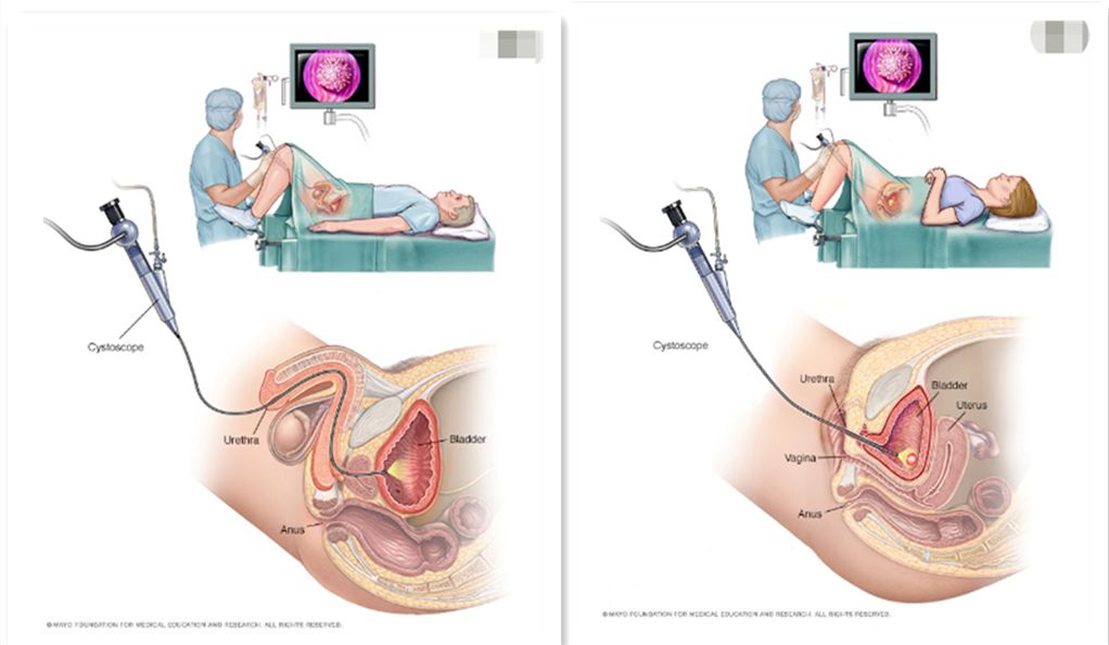 女性尿鲜红色血是什么原因,尿里有血2个加什么原因严重吗
