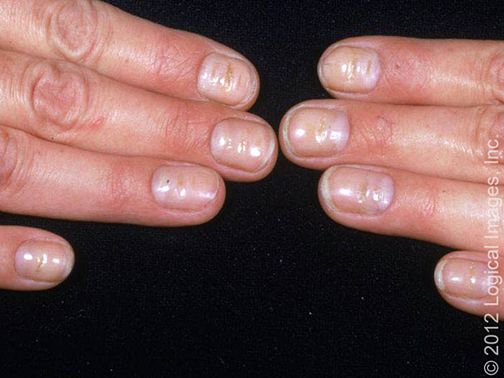 指甲很脆是因为缺少什么营养素,婴儿指甲特别脆是缺乏营养么