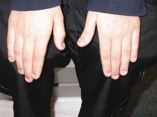 指甲很脆是因为缺少什么营养素,婴儿指甲特别脆是缺乏营养么