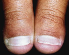 指甲很脆是因为缺少什么营养素,婴儿指甲特别脆是缺乏营养么