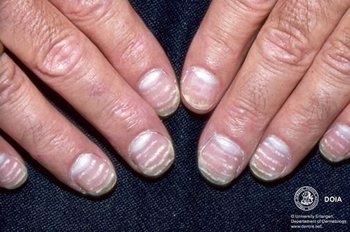 指甲很脆是因为缺少什么营养素,婴儿指甲特别脆是缺乏营养么