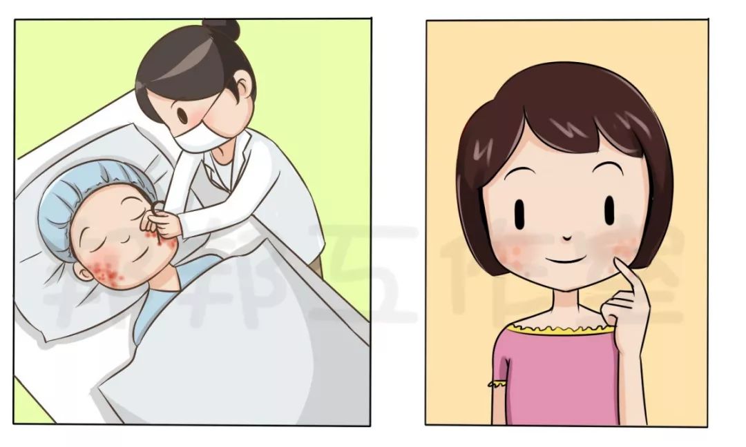 治痘印最有效的方法,有什么偏方祛痘印