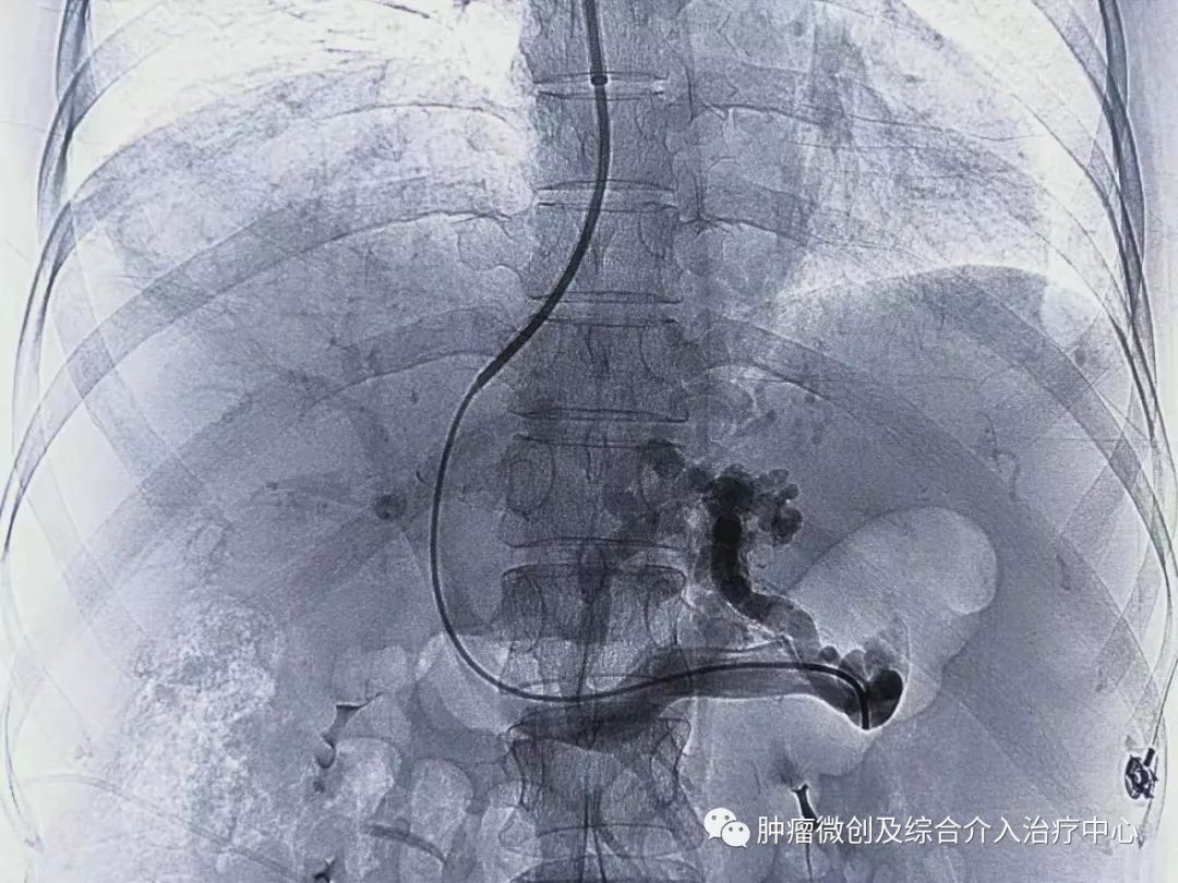 难治性消化道出血及难治性腹水的微创介入治疗-TIPS,运城市第一医院综合介入科