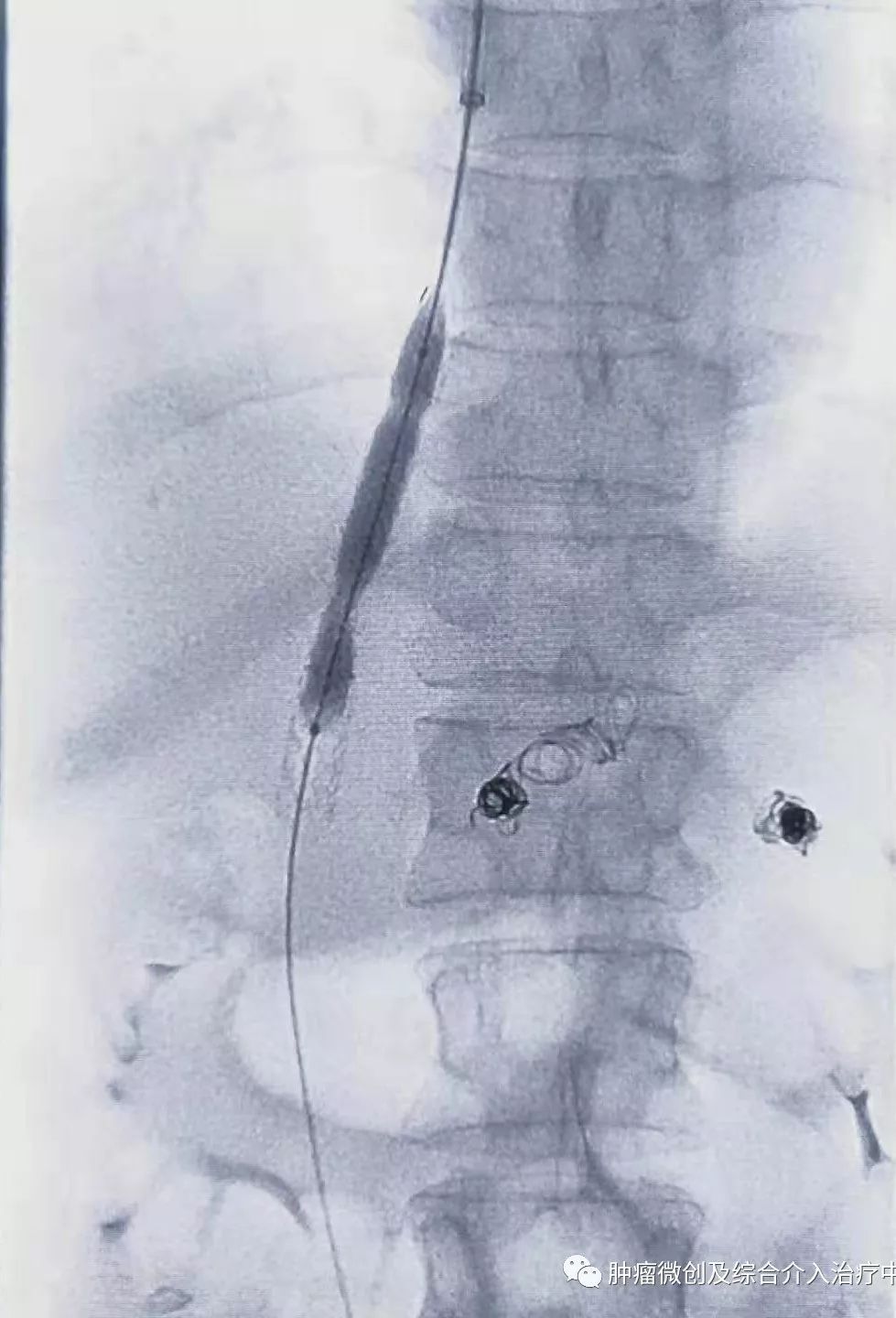 难治性消化道出血及难治性腹水的微创介入治疗-TIPS,运城市第一医院综合介入科