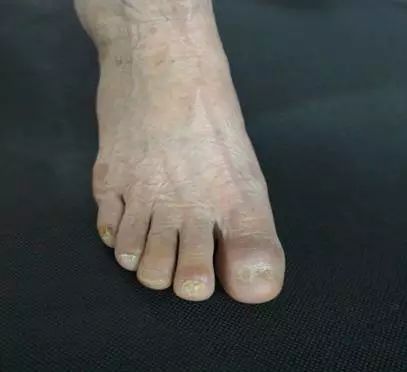 这画面太美！七旬阿婆脚拇趾疼痛流脓2年，原来竟是小东西惹的大祸