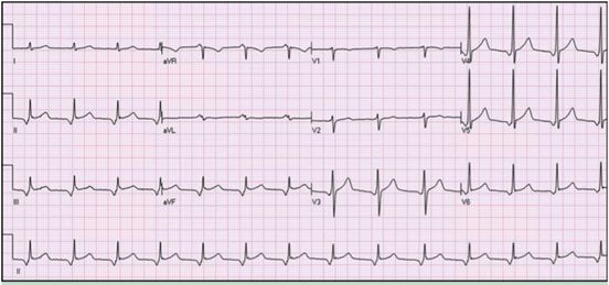st段呈异常动态变化,st段动态改变提示什么
