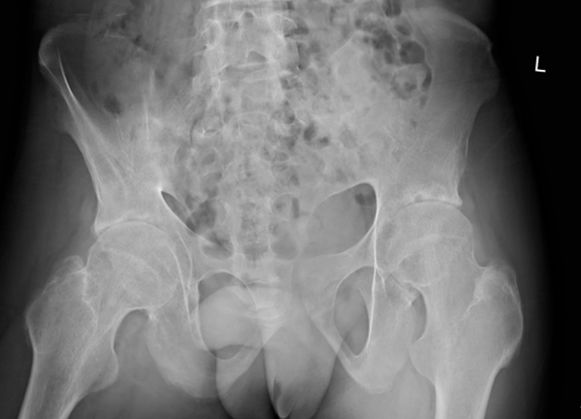 骨道堂治疗强直性脊柱炎效果,御医堂治疗强直性脊柱炎