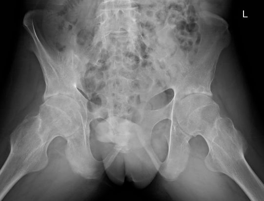 骨道堂治疗强直性脊柱炎效果,御医堂治疗强直性脊柱炎