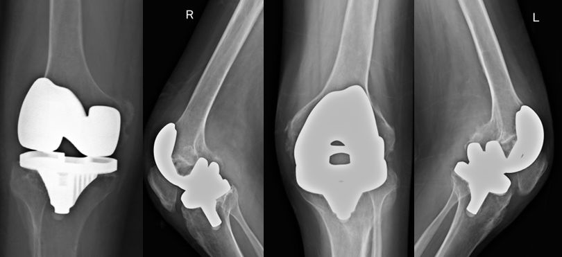 骨道堂治疗强直性脊柱炎效果,御医堂治疗强直性脊柱炎