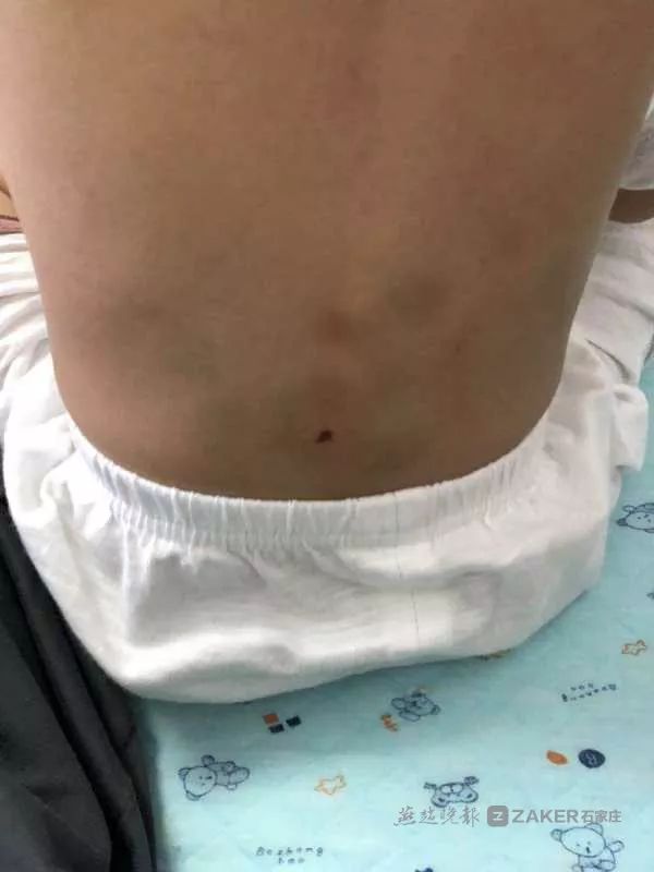 河北保定孩子受伤母亲求助后续,保定幼儿园学生受伤