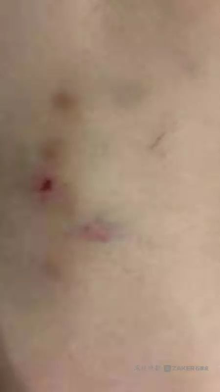 河北保定孩子受伤母亲求助后续,保定幼儿园学生受伤