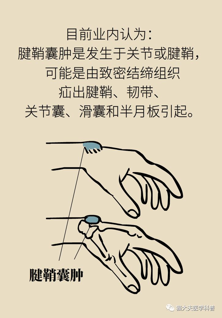 手腕长腱鞘囊肿,小孩手腕起了一个腱鞘囊肿要紧吗