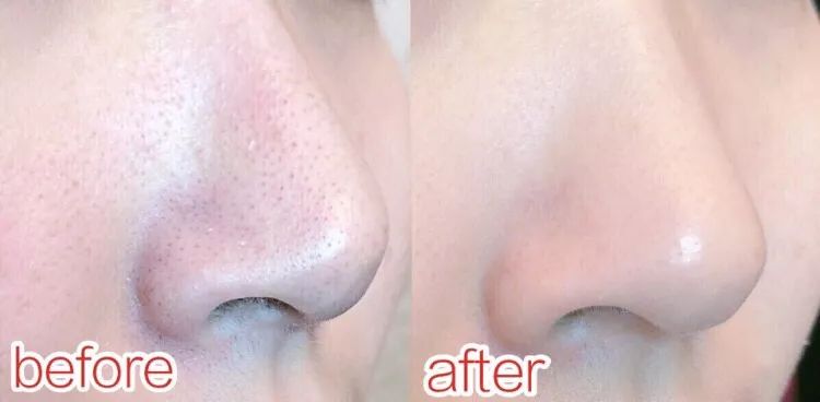 毛孔清道夫冻膜,毛孔清道夫细胞精华驻颜冻膜