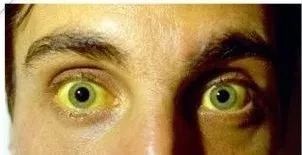 黄疸的四大症状,五种黄疸病