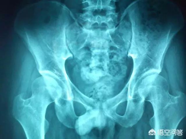 宝宝腿纹不对称髋关节正常的,婴儿腿褶不对称