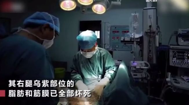 小孩腿上的蚊子包抓破留下的疤痕,4岁女童蚊子包