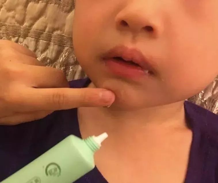 保湿、消炎、止痒、晒后修复，一管芦荟胶全搞定，宝宝也能用