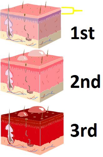 找真相|烫伤抹牙膏?鱼刺卡喉要喝醋?这些家庭急救误区你不可不知