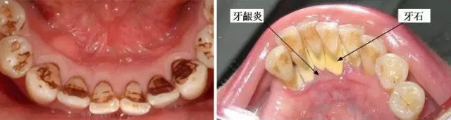 不用打磨牙齿的快速美白方法,不用洗牙能把牙垢黄牙变白的方法