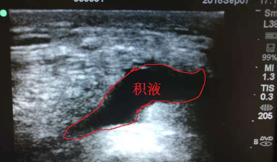 膝盖急性损伤肿过大腿,这样处理后她第二天竟好了八成