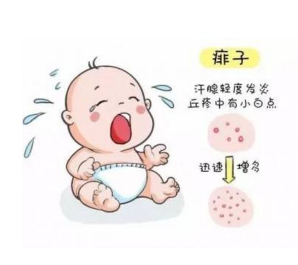 什么是痱子科普小知识,治疗严重痱子11个小偏方